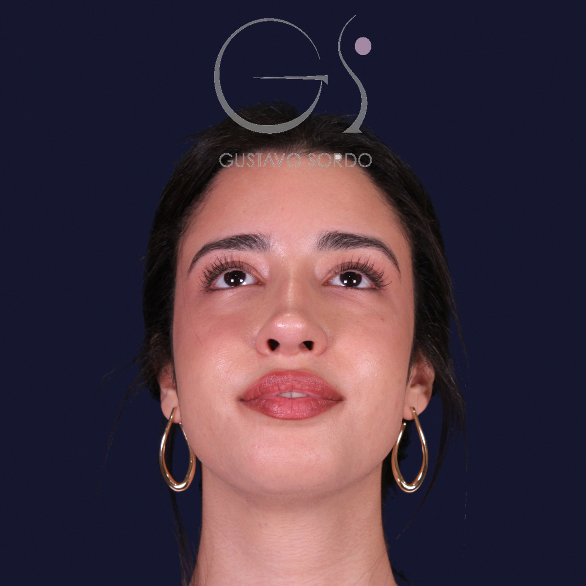 Rinoplastia de preservación con mentoplastia, vista con el mentón arriba: resultado al año de la operación