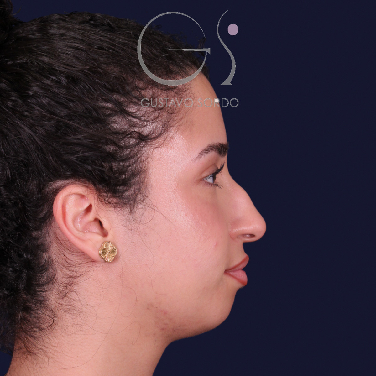 Rinoplastia de preservación con mentoplastia, perfil derecho: antes de la operación