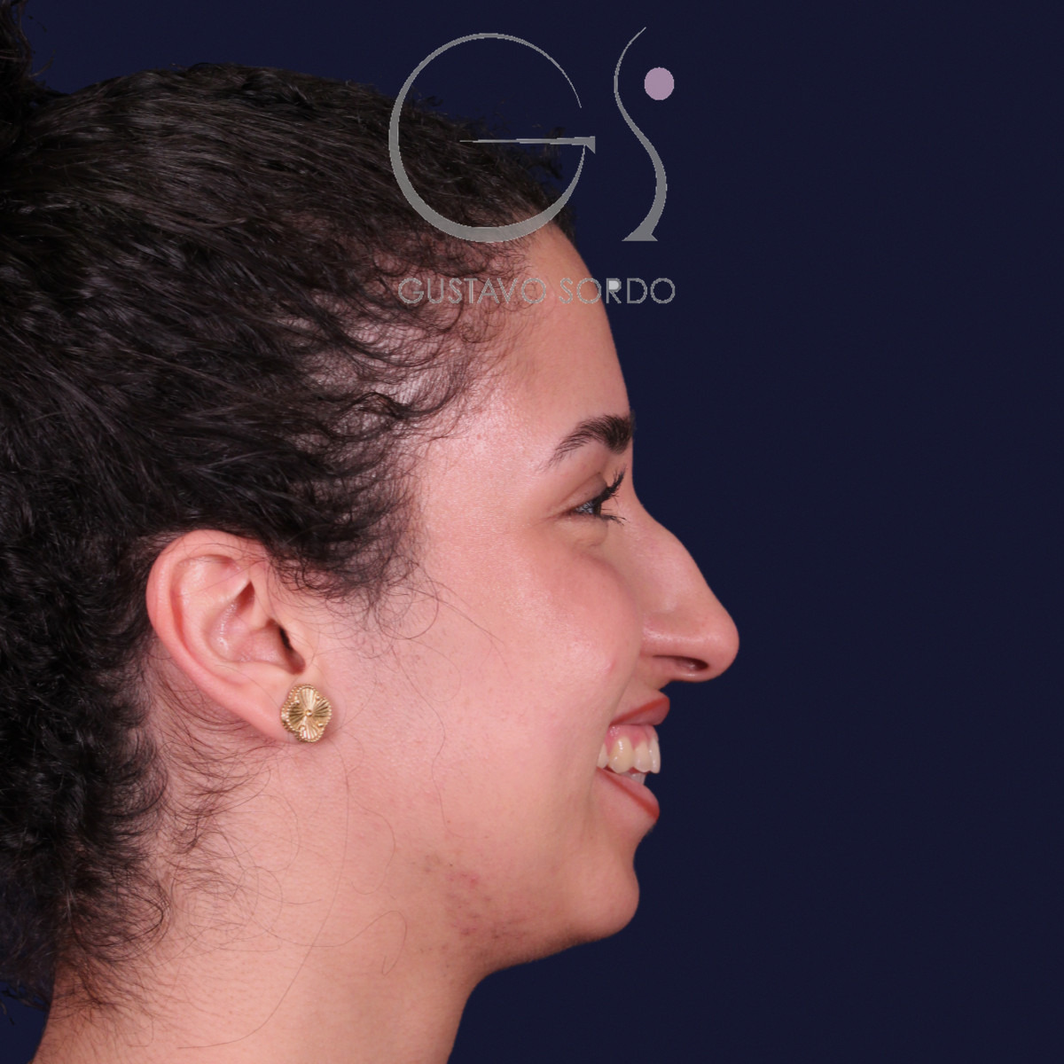 Rinoplastia de preservación con mentoplastia, perfil derecho sonriendo: antes de la operación
