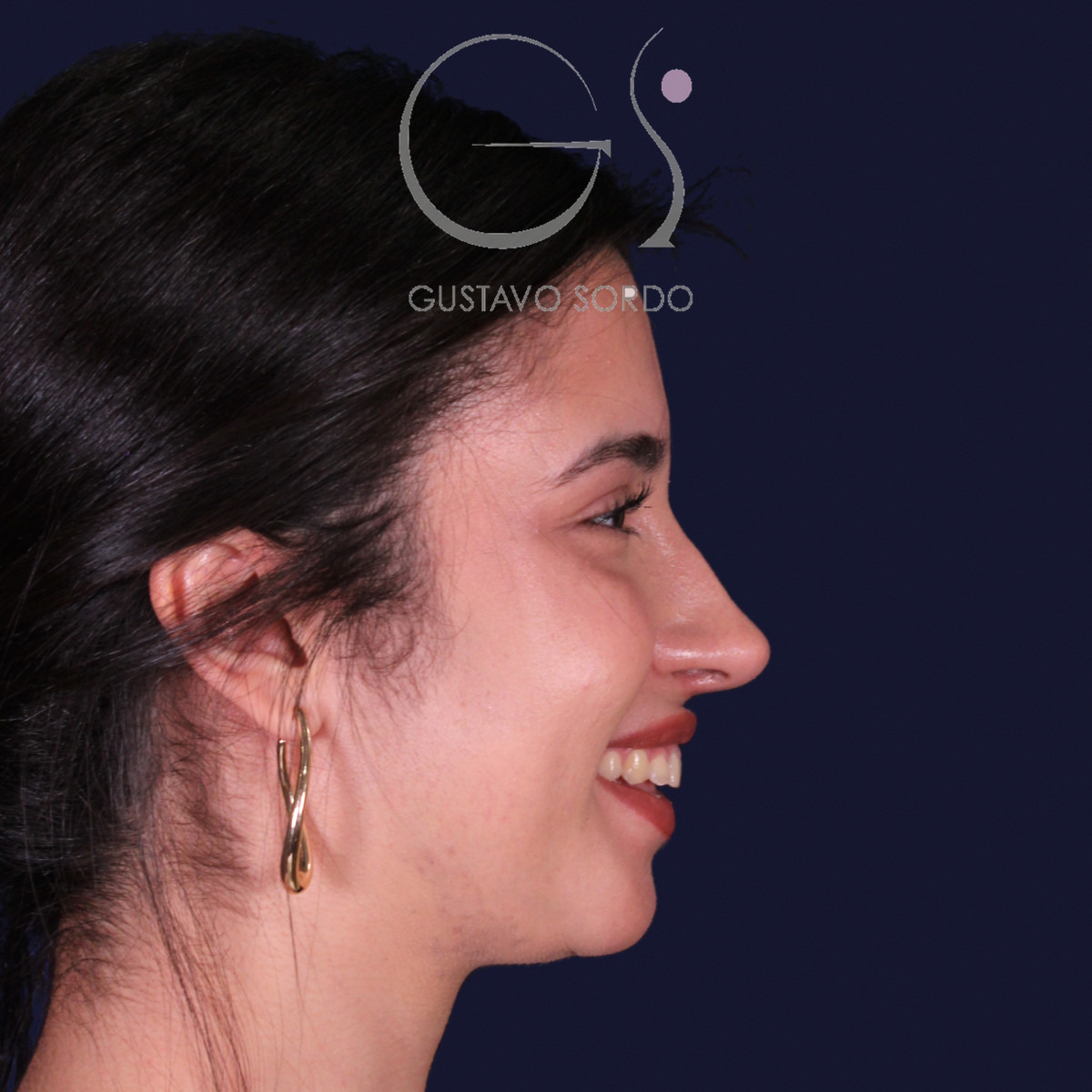 Rinoplastia de preservación con mentoplastia, perfil derecho sonriendo: resultado al año de la operación