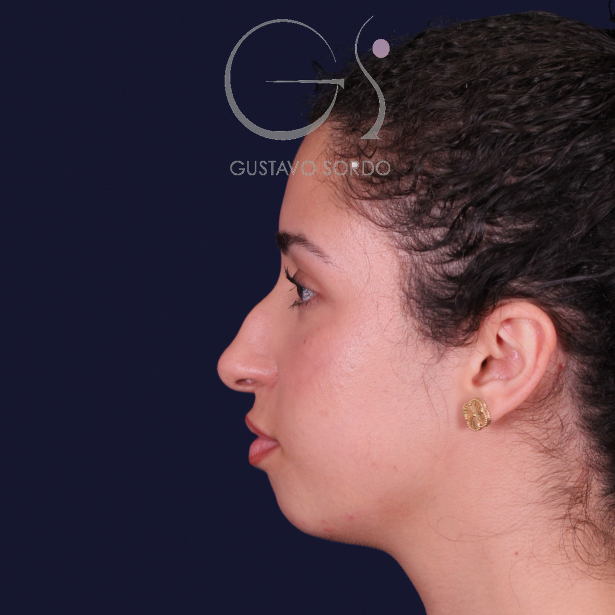Rinoplastia de preservación con mentoplastia, perfil izquierdo: antes de la operación
