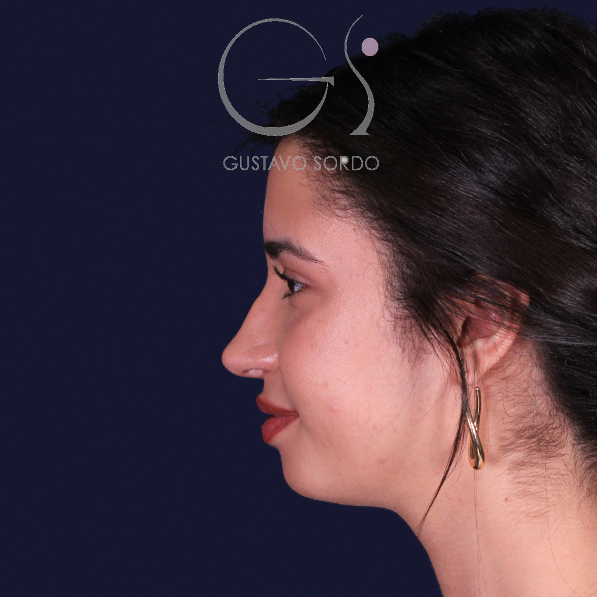 Rinoplastia de preservación con mentoplastia, perfil izquierdo: resultado al año de la operación