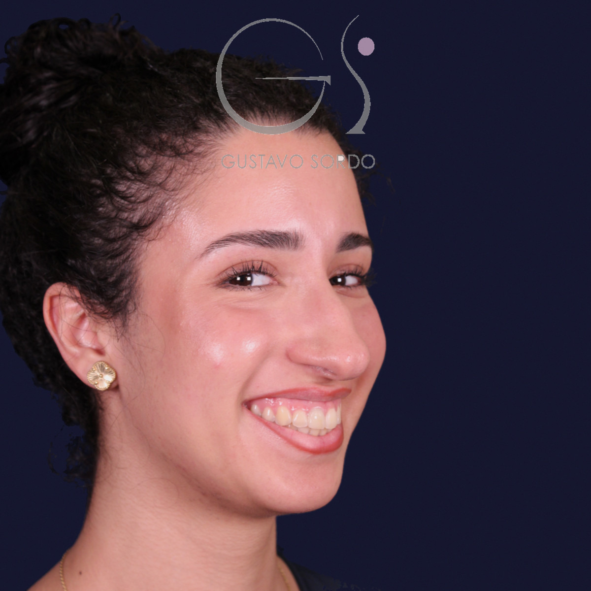 Rinoplastia de preservación con mentoplastia, semiperfil derecho: antes de la operación
