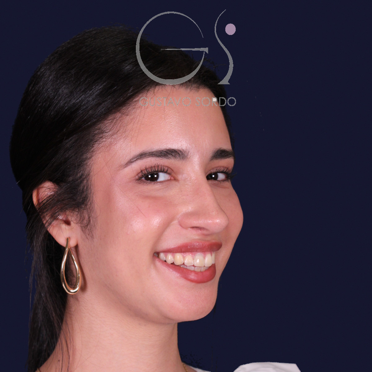 Rinoplastia de preservación con mentoplastia, semiperfil derecho: resultado al año de la operación