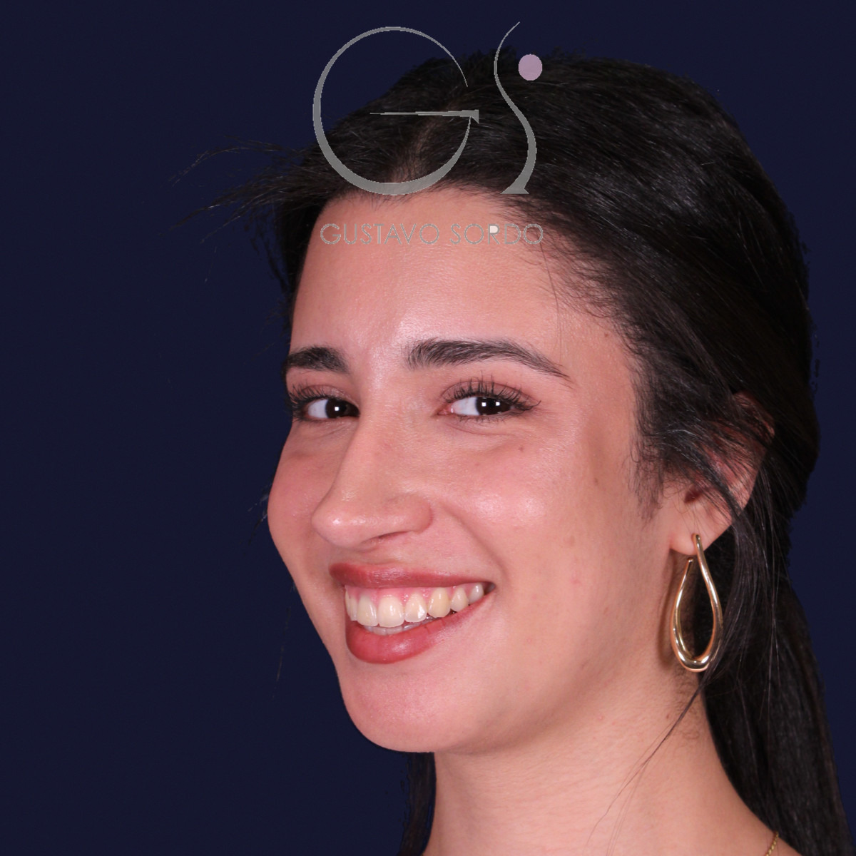 Rinoplastia de preservación con mentoplastia, semiperfil izquierdo: resultado al año de la operación