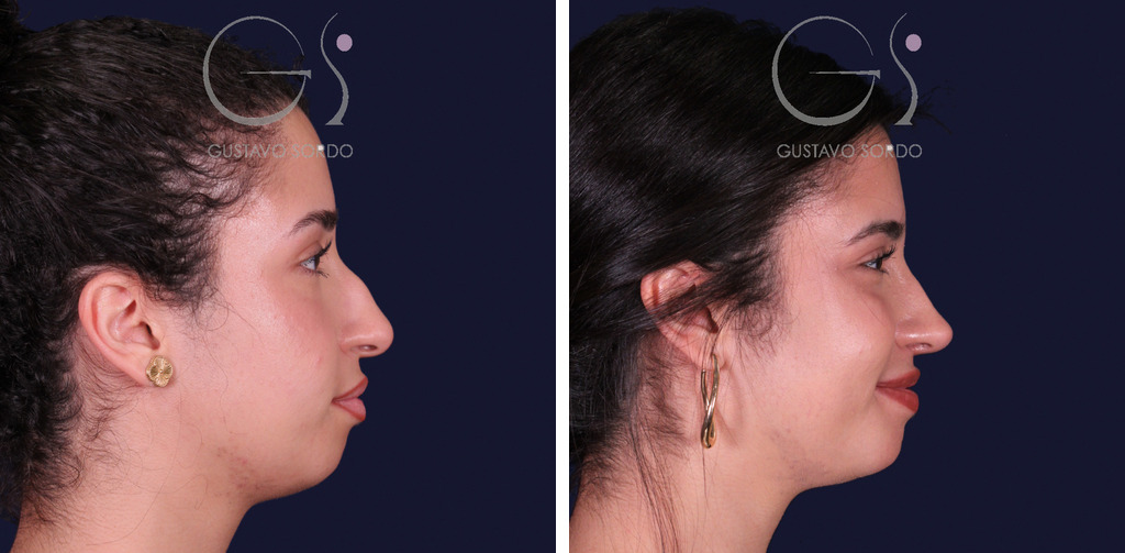 Rinoplastia de preservación con mentoplastia: antes y después al año de un caso operado en Madrid