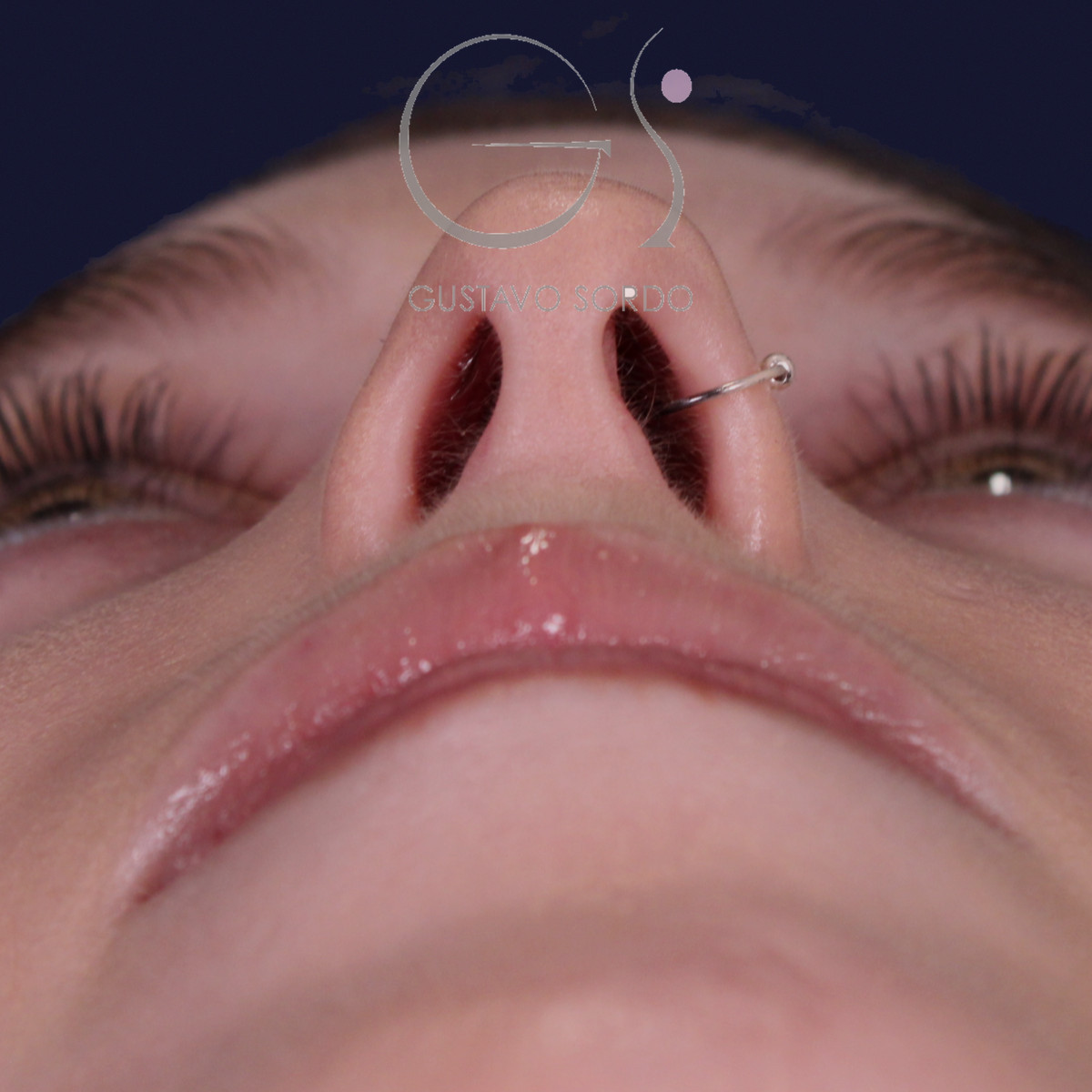 Rinoplastia de preservación con punta en armadillo, vista basal: antes de la operación