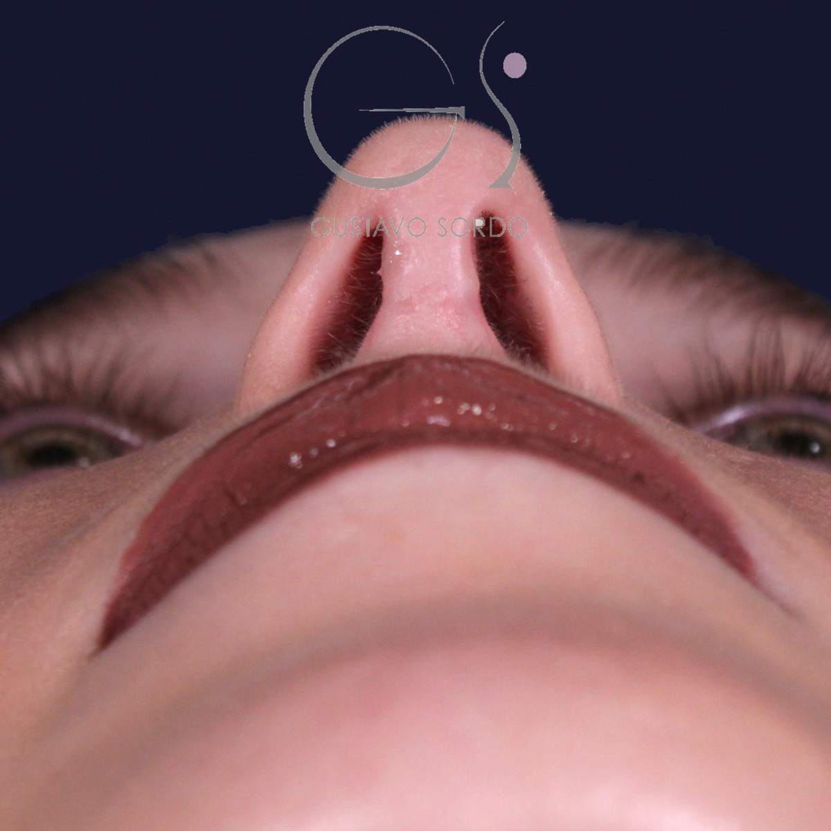 Rinoplastia de preservación con punta en armadillo, vista basal: resultado a los 7 meses
