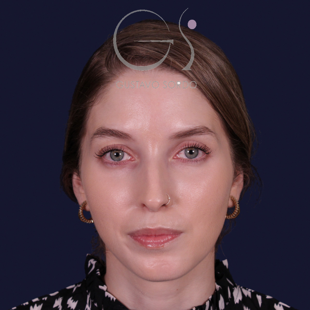 Rinoplastia de preservación con punta en armadillo, vista frontal: antes de la operación