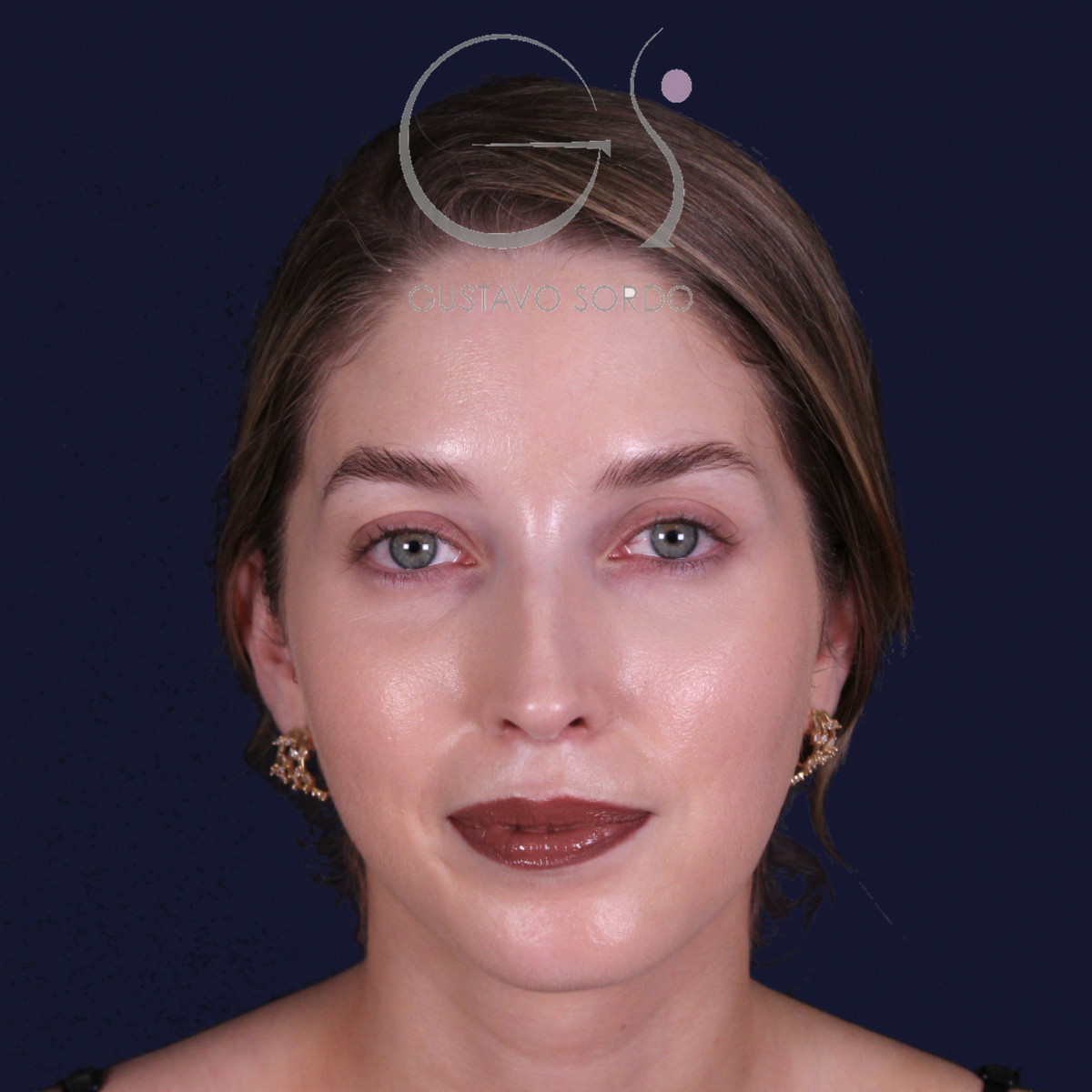 Rinoplastia de preservación con punta en armadillo, vista frontal: resultado a los 7 meses