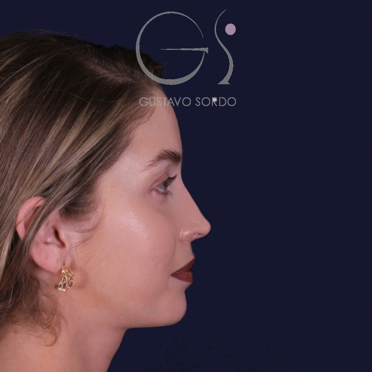 Rinoplastia de preservación con punta en armadillo, perfil derecho: resultado a los 7 meses