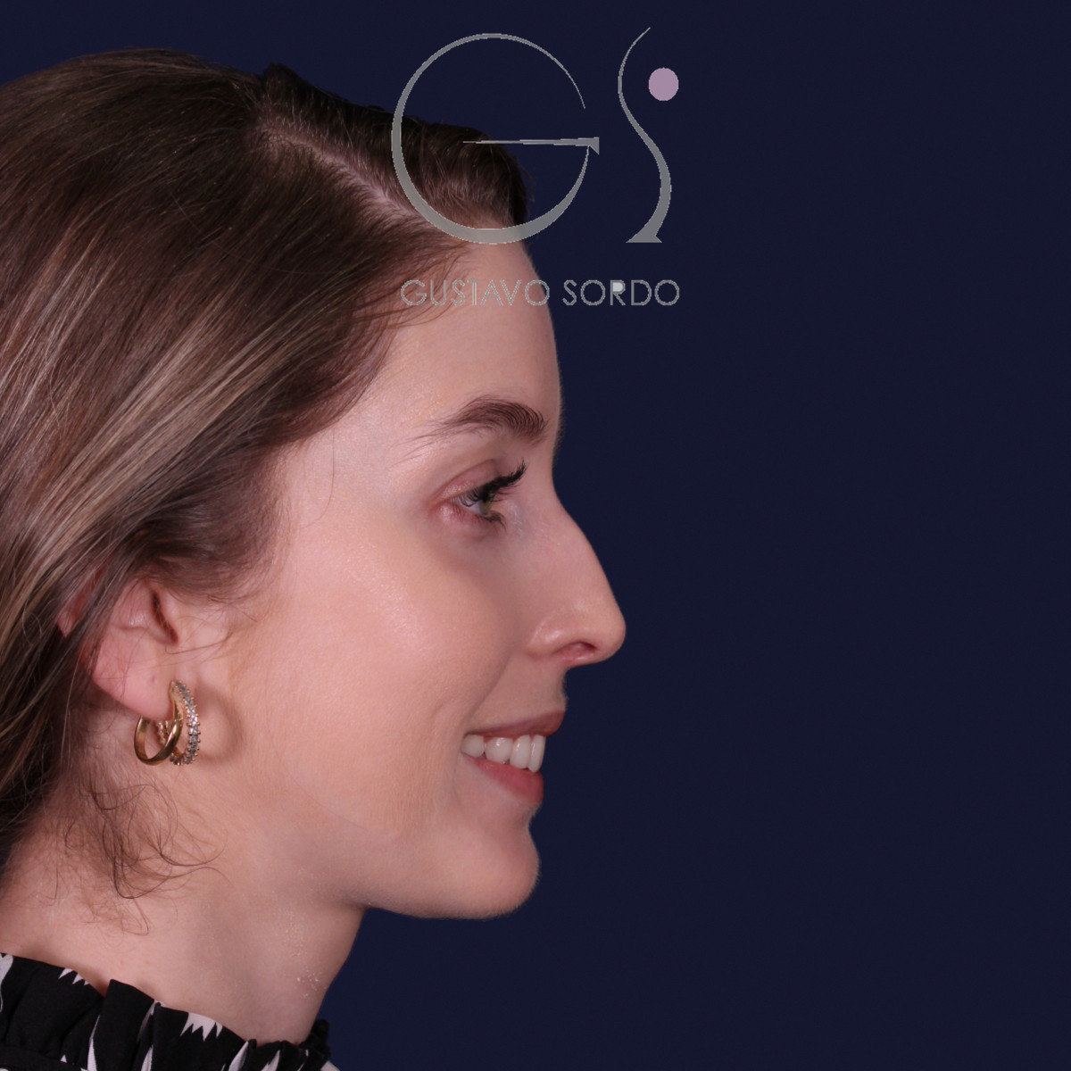 Rinoplastia de preservación con punta en armadillo, perfil derecho sonriendo: antes de la operación