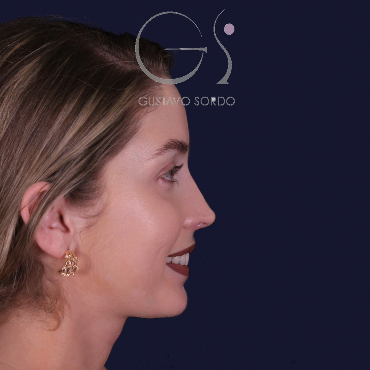 Rinoplastia de preservación con punta en armadillo, perfil derecho sonriendo: resultado a los 7 meses