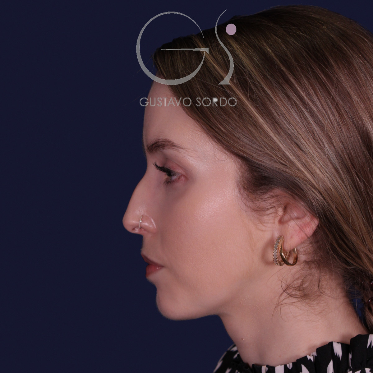 Rinoplastia de preservación con punta en armadillo, perfil izquierdo: antes de la operación