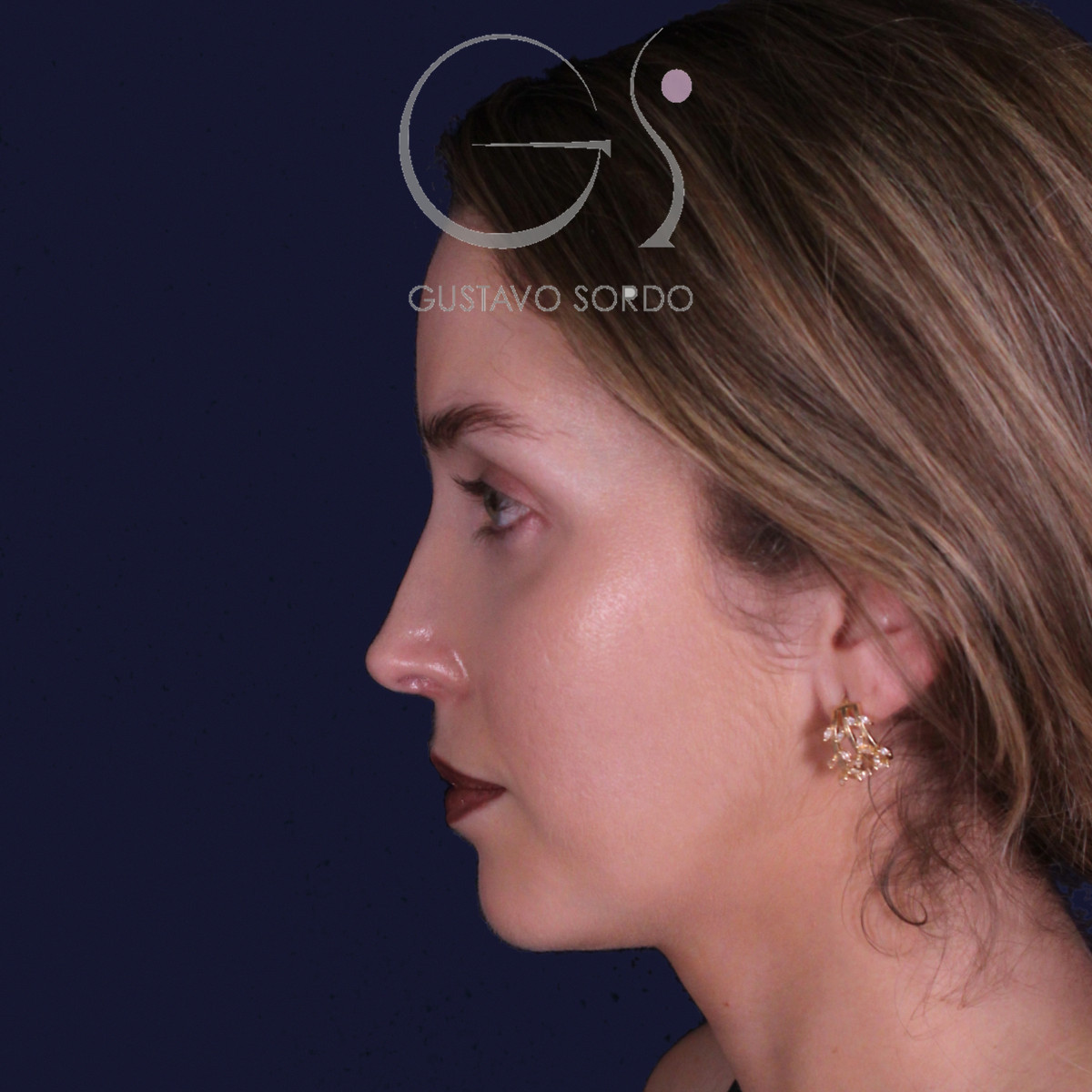Rinoplastia de preservación con punta en armadillo, perfil izquierdo: resultado a los 7 meses