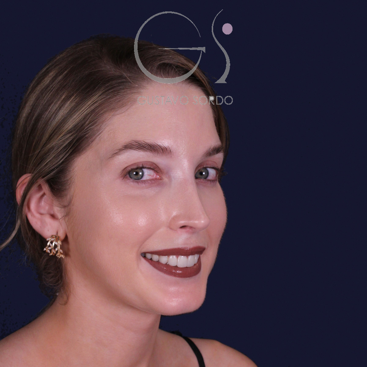 Rinoplastia de preservación con punta en armadillo, semiperfil derecho: resultado a los 7 meses