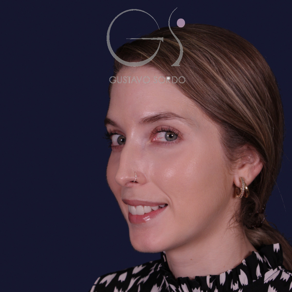 Rinoplastia de preservación con punta en armadillo, semiperfil izquierdo: antes de la operación