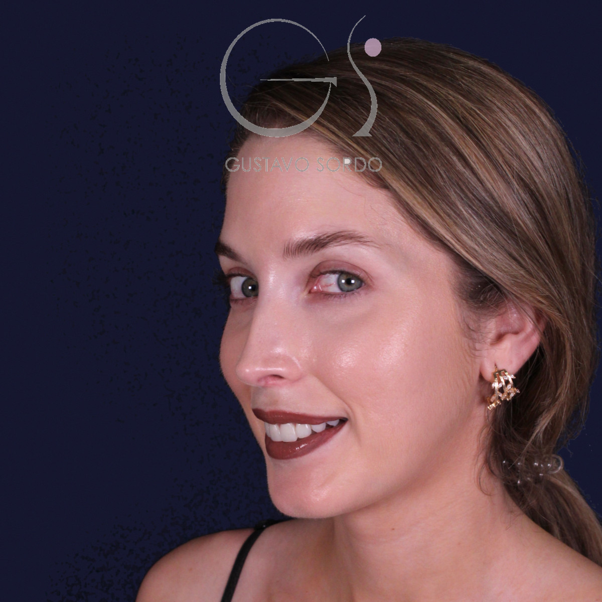 Rinoplastia de preservación con punta en armadillo, semiperfil izquierdo: resultado a los 7 meses