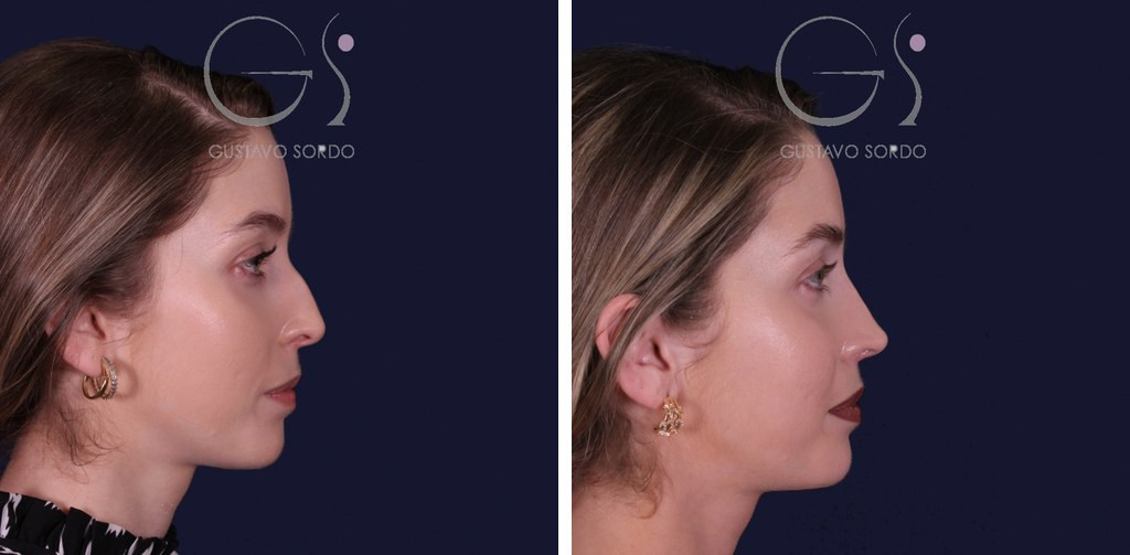 Rinoplastia de preservación con punta en armadillo en piel fina: antes y después de un caso operado en Madrid