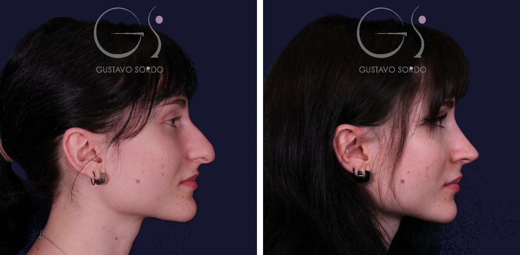 Rinoplastia de preservación Nakamura en punta caída y bulbosa: antes y después de un caso operado en Madrid