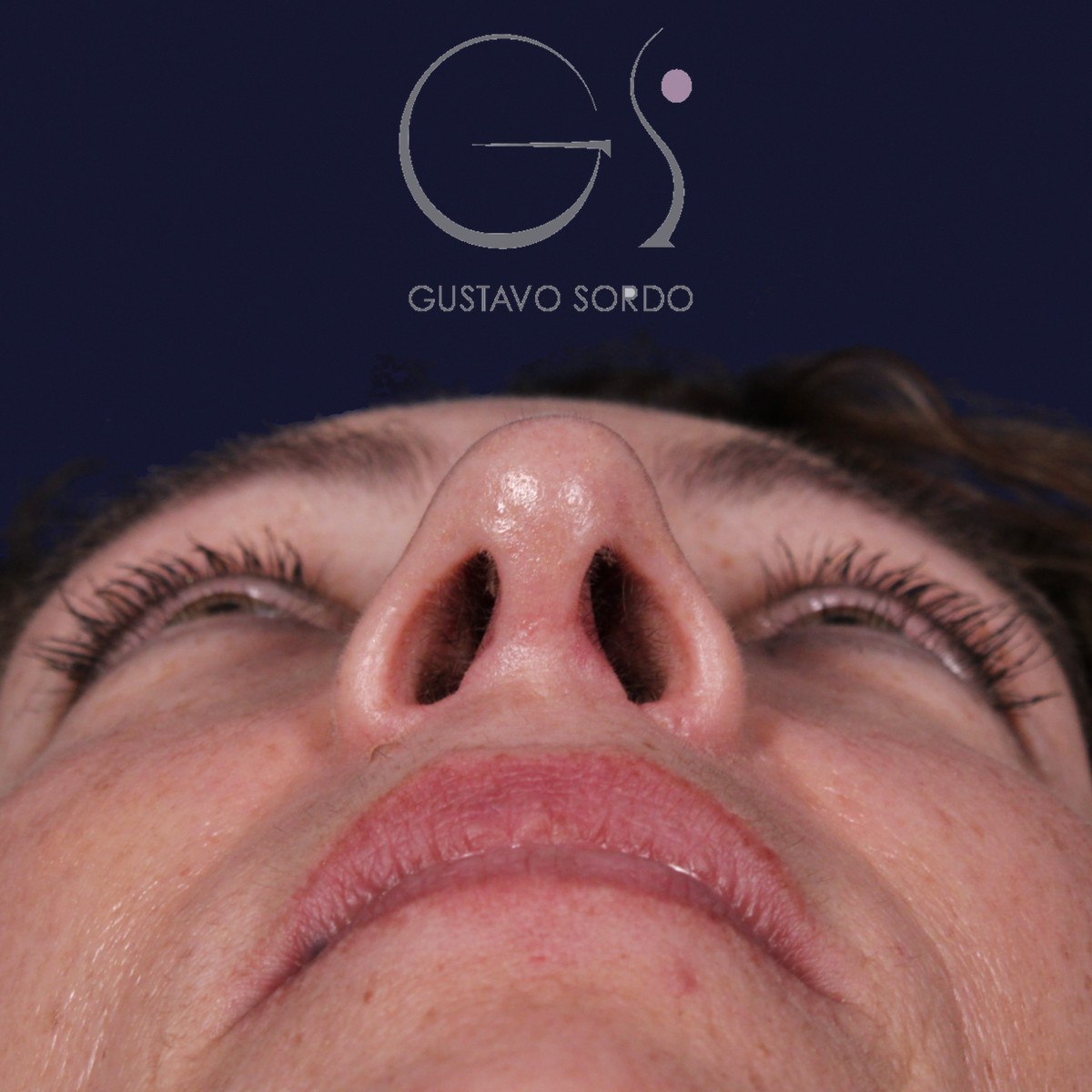 Rinoplastia de preservación SPQR en nariz desviada, vista basal: resultado a los 6 meses