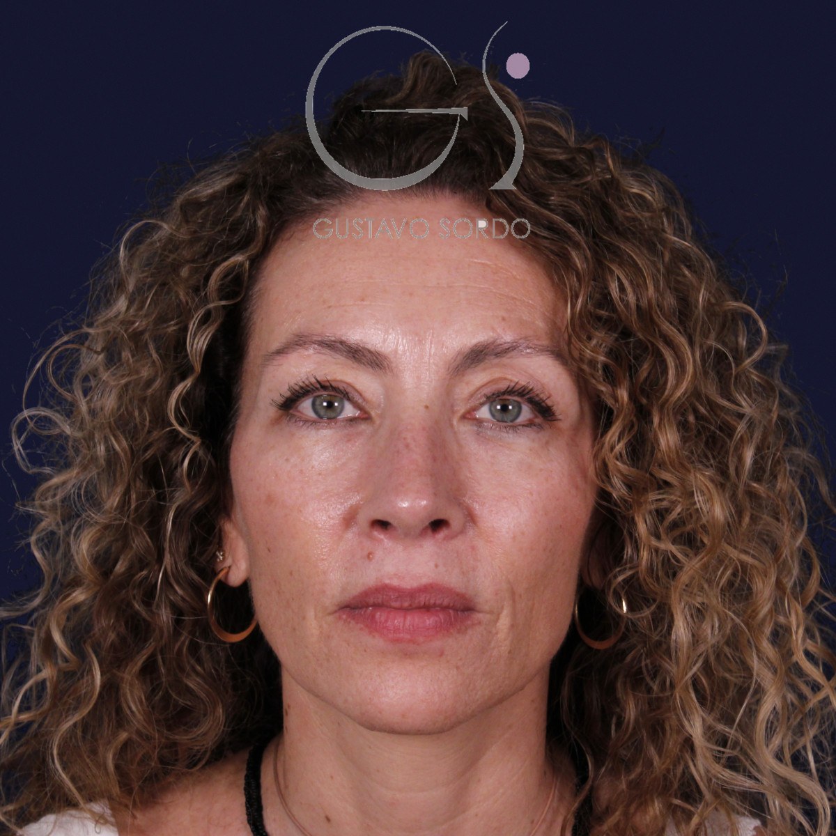 Rinoplastia de preservación SPQR en nariz desviada, de frente: resultado a los 6 meses