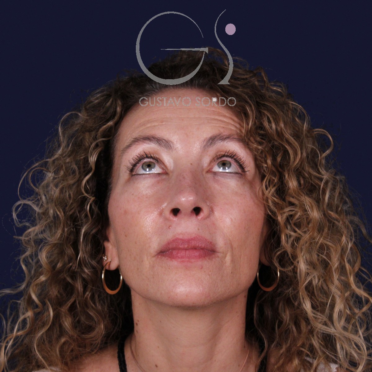 Rinoplastia de preservación SPQR en nariz desviada, mentón arriba: resultado a los 6 meses