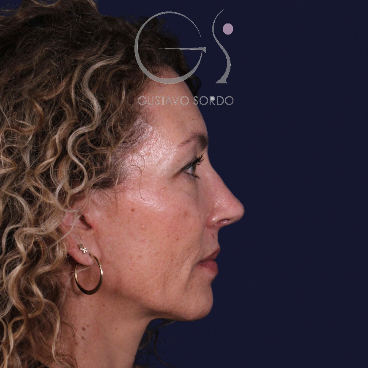 Rinoplastia de preservación SPQR en nariz desviada, perfil derecho: resultado a los 6 meses