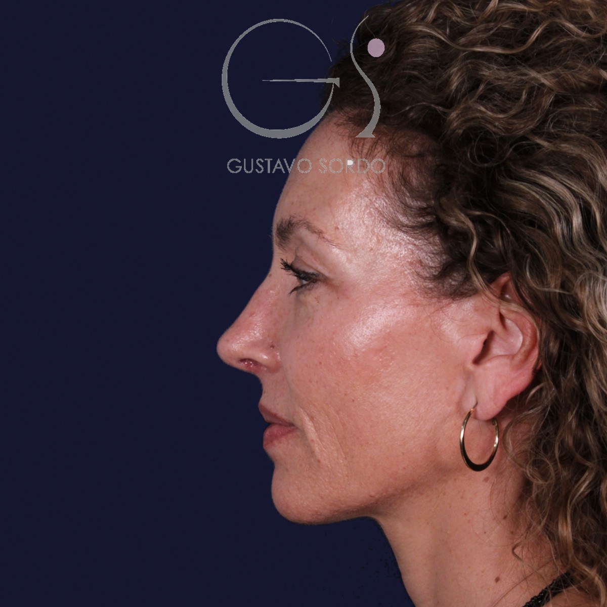Rinoplastia de preservación SPQR en nariz desviada, perfil izquierdo: resultado a los 6 meses