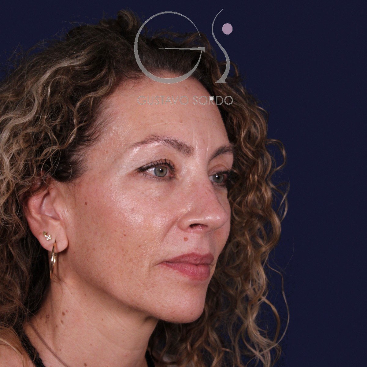 Rinoplastia de preservación SPQR en nariz desviada, semiperfil derecho: resultado a los 6 meses