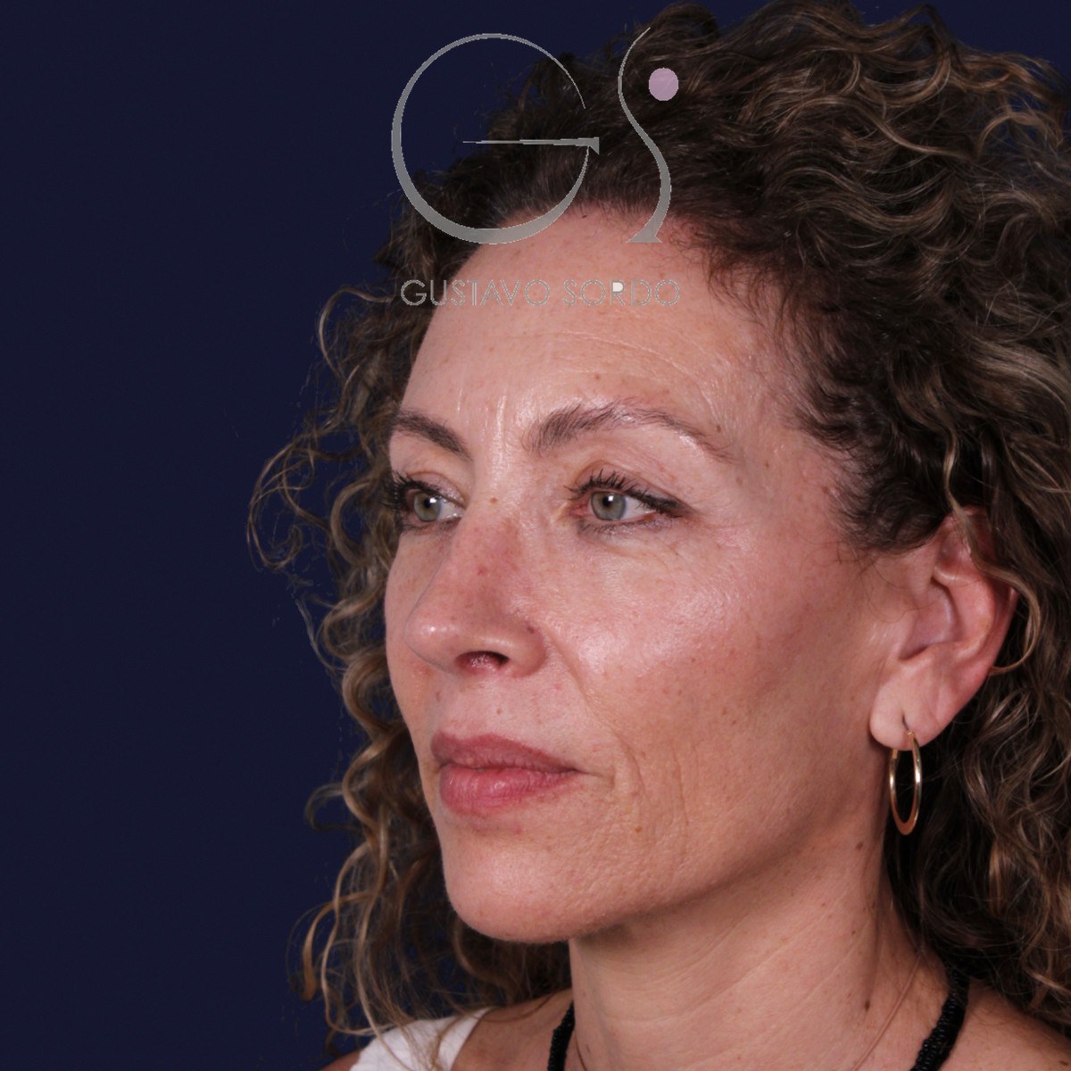 Rinoplastia de preservación SPQR en nariz desviada, semiperfil izquierdo: resultado a los 6 meses