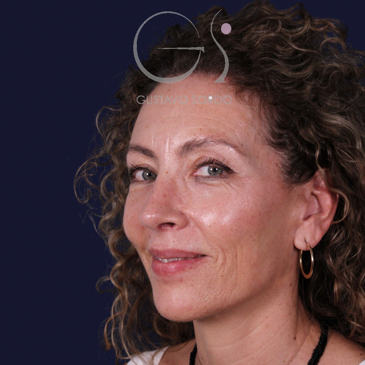 Rinoplastia de preservación SPQR en nariz desviada, semiperfil izquierdo sonriendo: resultado a los 6 meses