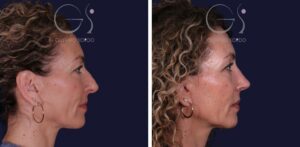 Rinoplastia de preservación SPQR en nariz desviada