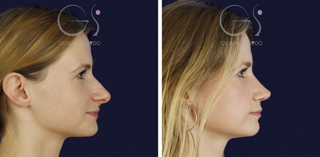 Rinoplastia en punta bulbosa y caballete: antes y a los seis meses, perfil derecho