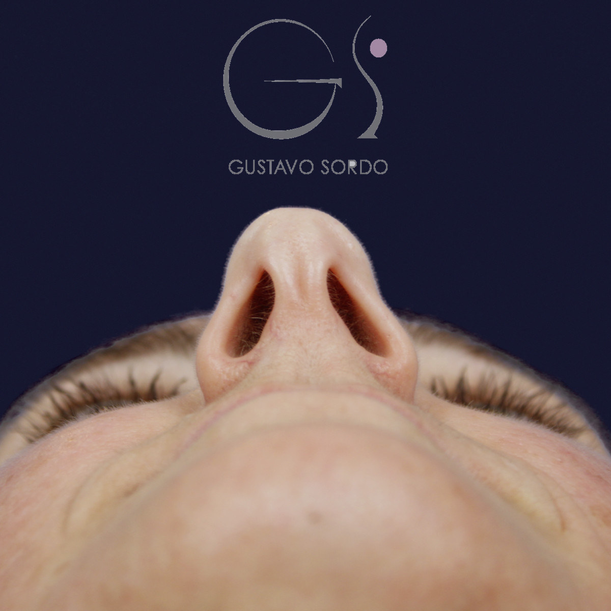 Antes de rinoplastia con radix bajo, caballete y punta bífida, vista basal, desde abajo