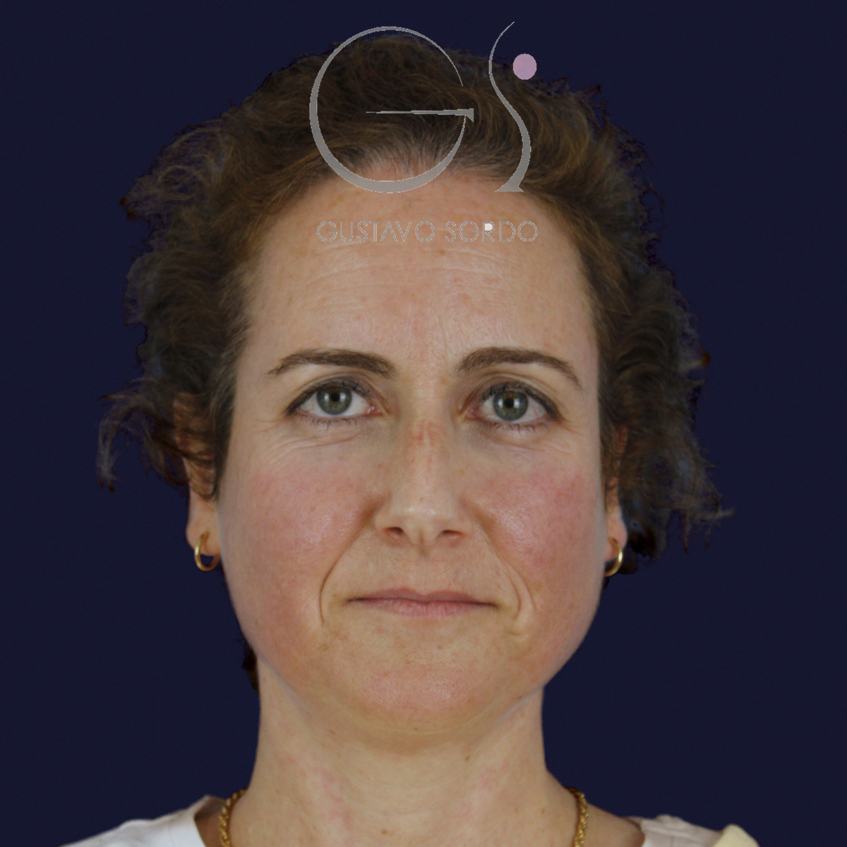 Antes de rinoplastia con radix bajo, caballete y punta bífida, vista frontal