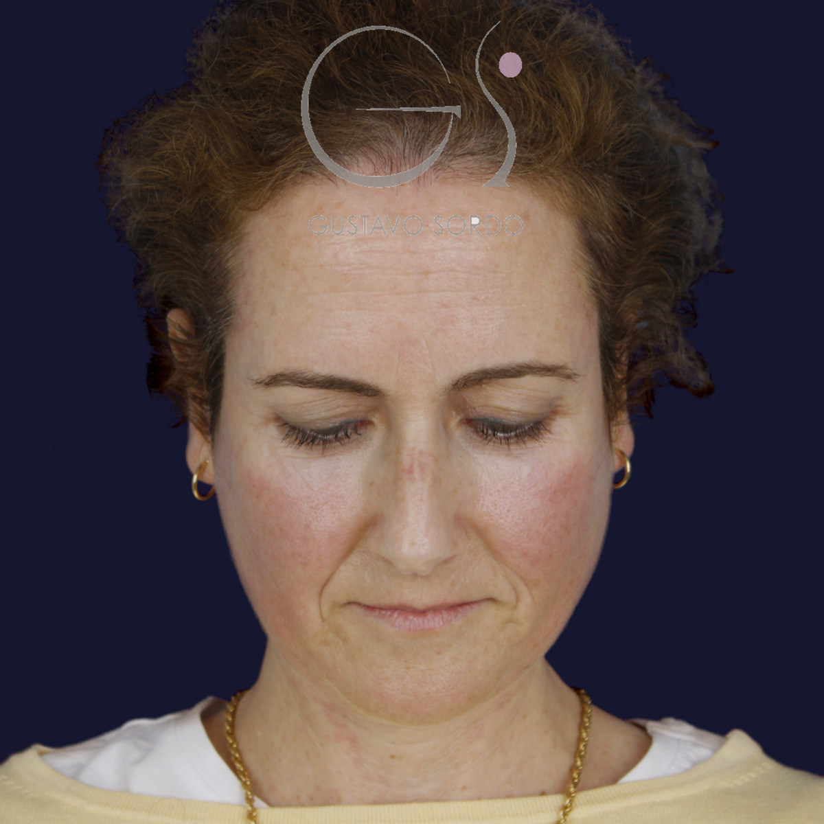 Antes de rinoplastia con radix bajo, caballete y punta bífida, vista frontal con el mentón abajo