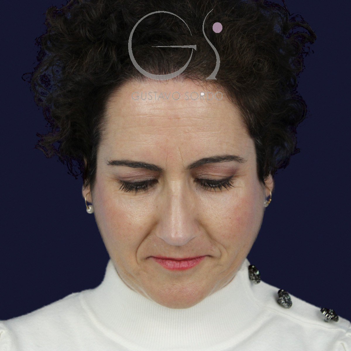 Después de rinoplastia con radix bajo, caballete y punta bífida, a los 14 meses, vista frontal con el mentón abajo