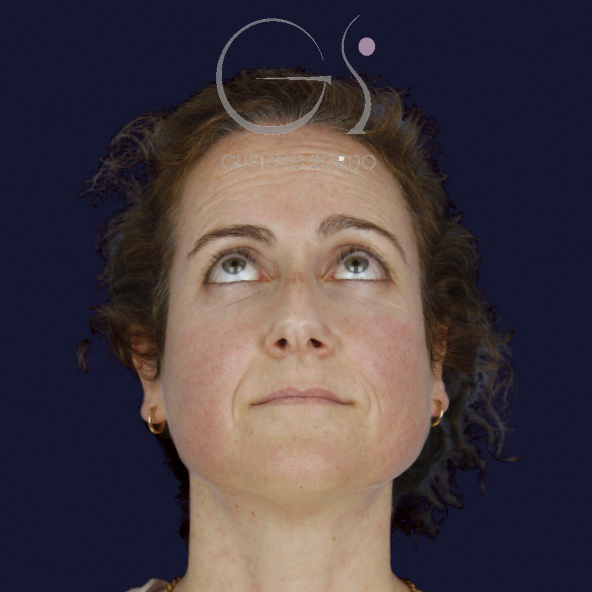 Antes de rinoplastia con radix bajo, caballete y punta bífida, vista frontal con el mentón arriba