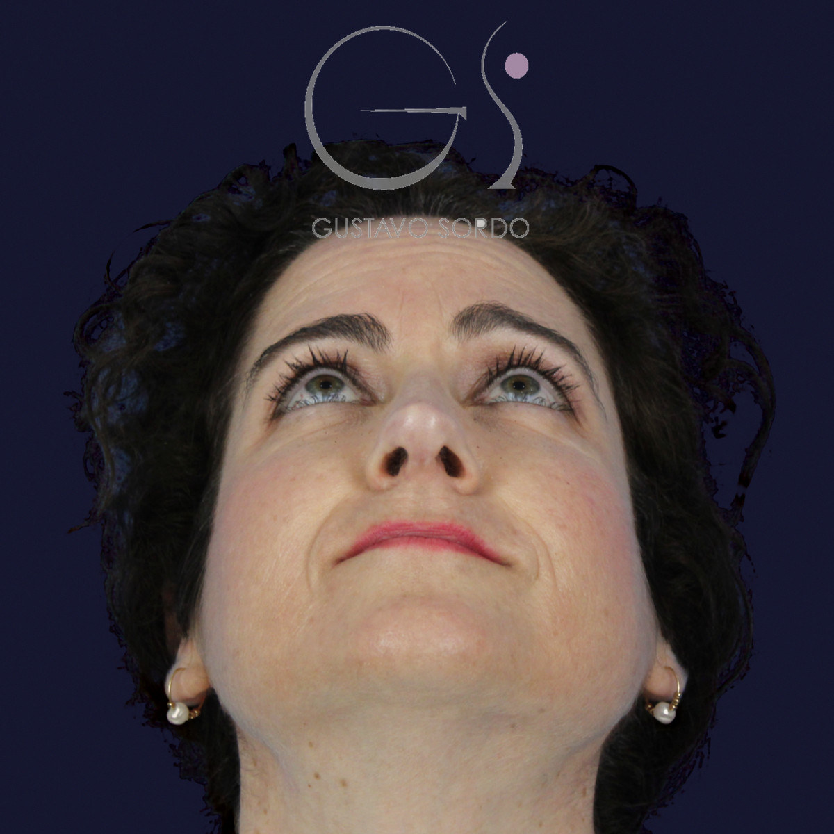 Después de rinoplastia con radix bajo, caballete y punta bífida, a los 14 meses, vista frontal con el mentón arriba