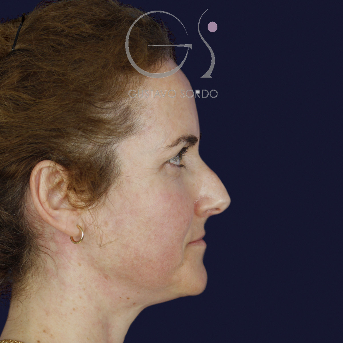 Antes de rinoplastia con radix bajo, caballete y punta bífida, vista de perfil derecho