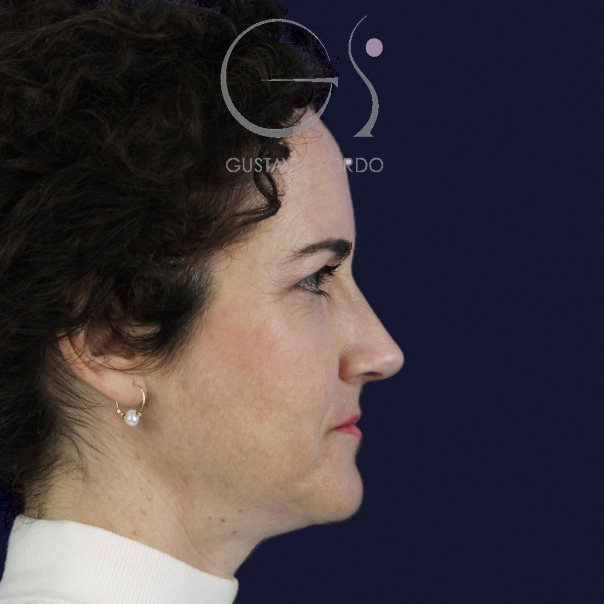 Después de rinoplastia con radix bajo, caballete y punta bífida, a los 14 meses, vista de perfil derecho