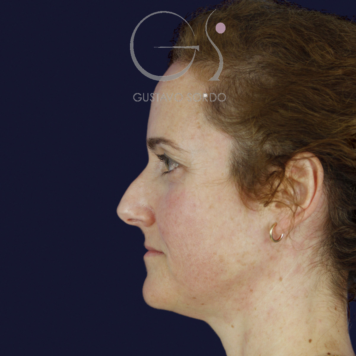 Antes de rinoplastia con radix bajo, caballete y punta bífida, vista de perfil izquierdo