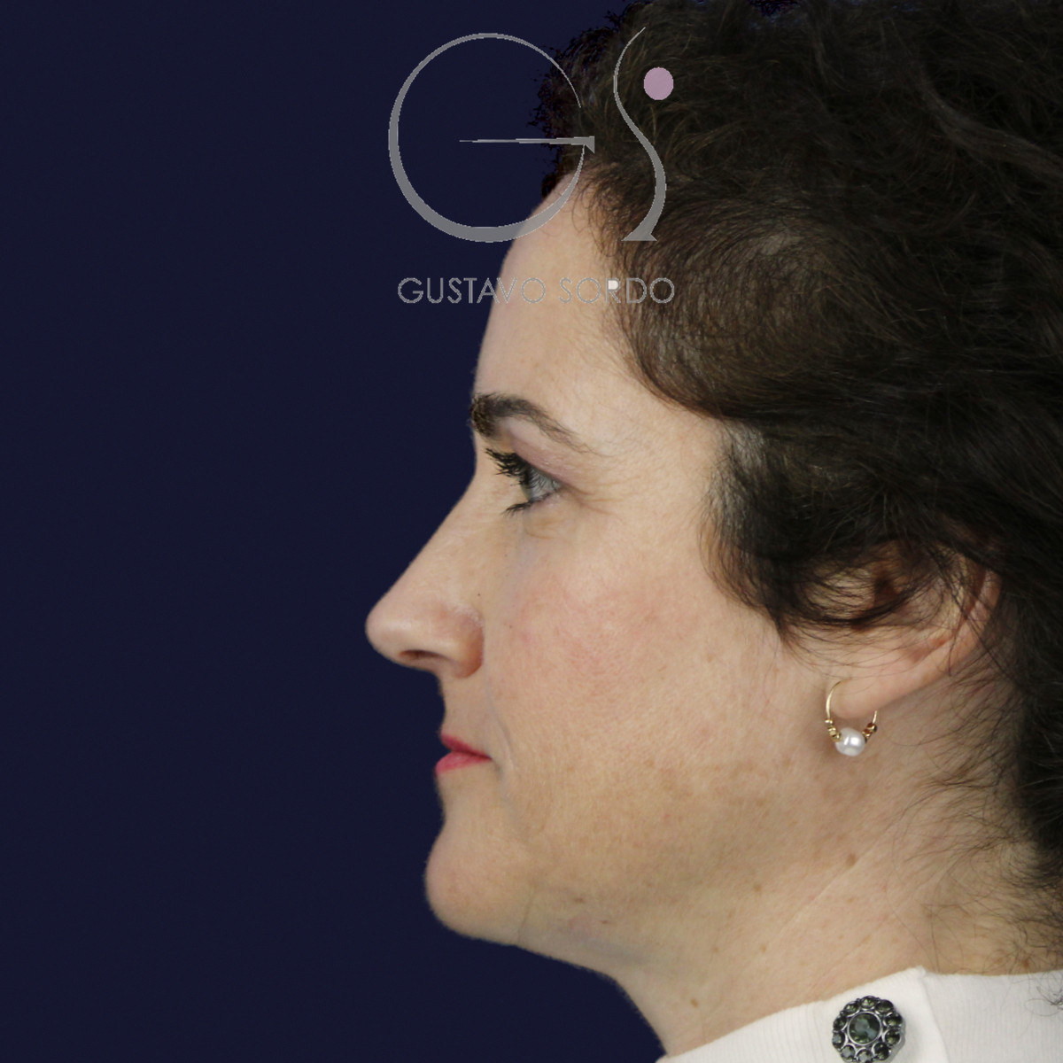 Después de rinoplastia con radix bajo, caballete y punta bífida, a los 14 meses, vista de perfil izquierdo