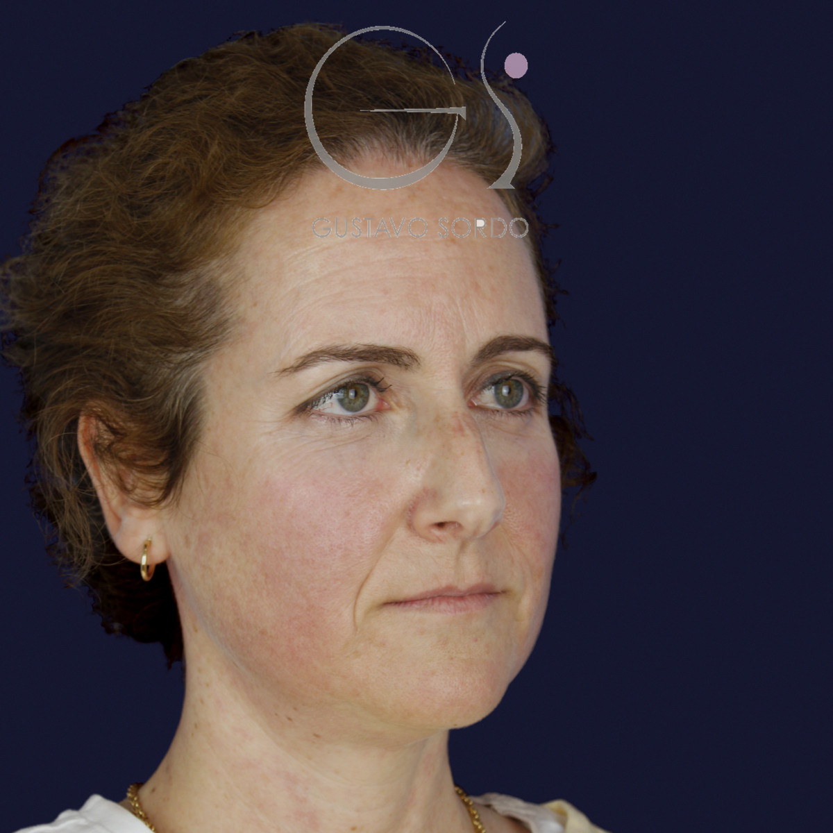 Antes de rinoplastia con radix bajo, caballete y punta bífida, vista de semiperfil derecho