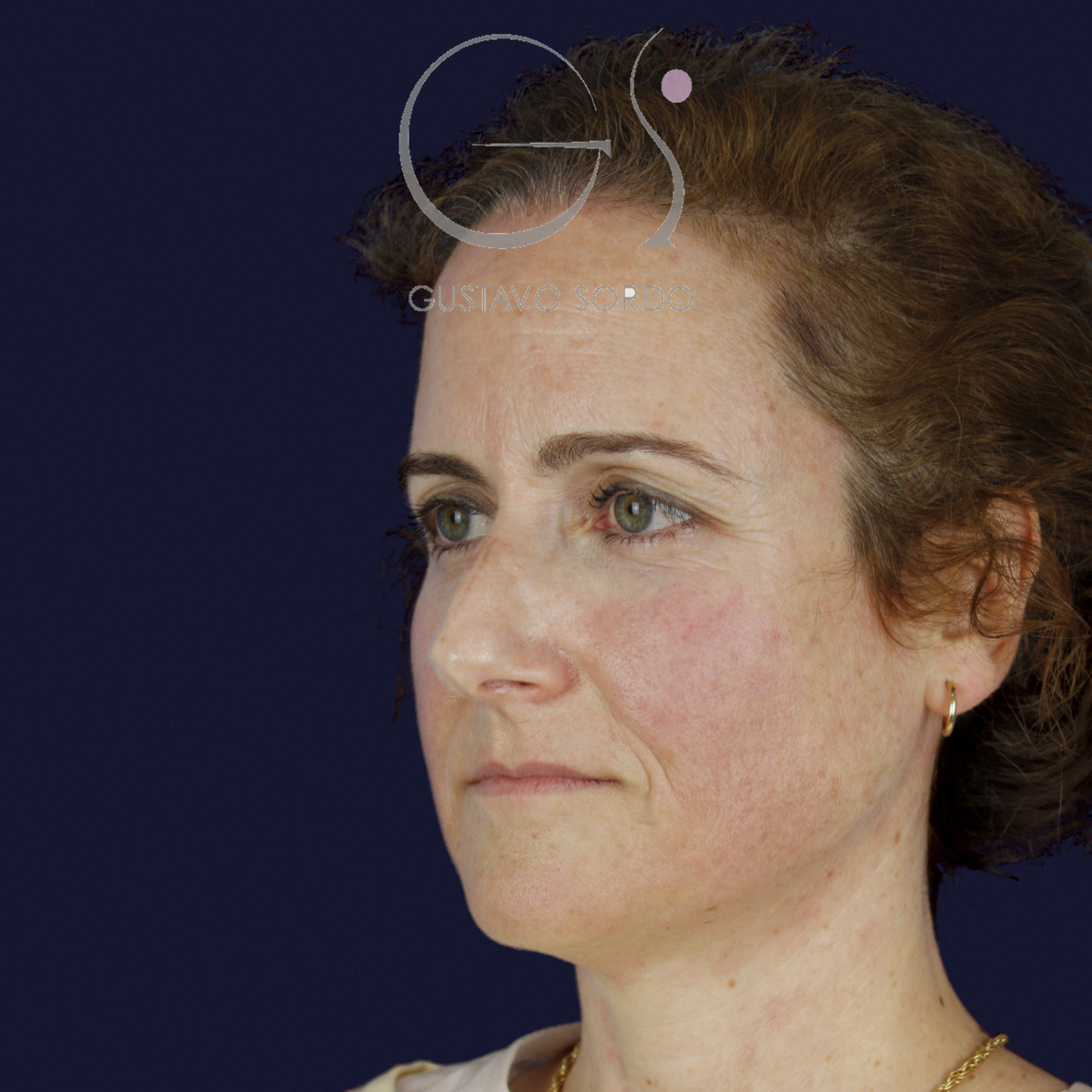 Antes de rinoplastia con radix bajo, caballete y punta bífida, vista de semiperfil izquierdo