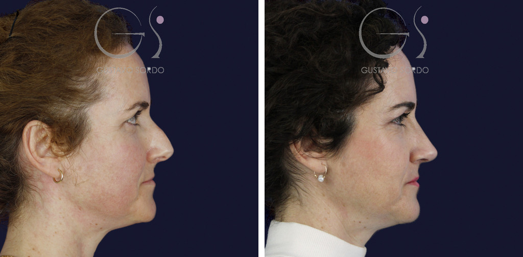 Rinoplastia con radix bajo, caballete y punta bífida: antes y a los 14 meses, perfil derecho