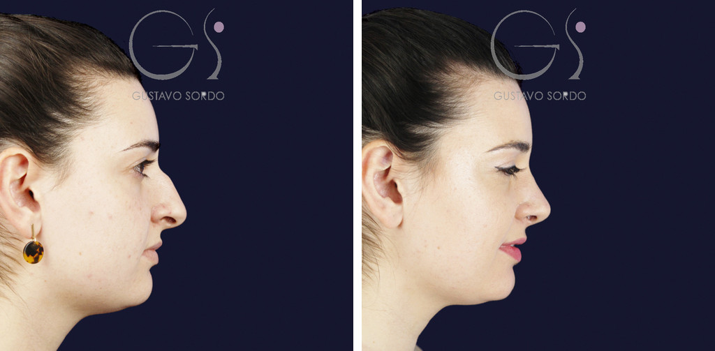 Rinoplastia para rebajar el caballete y definir la punta: antes y a los diez meses, perfil derecho