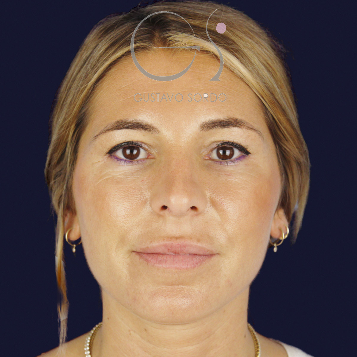 Antes de rinoplastia secundaria de la punta sin costilla, vista frontal