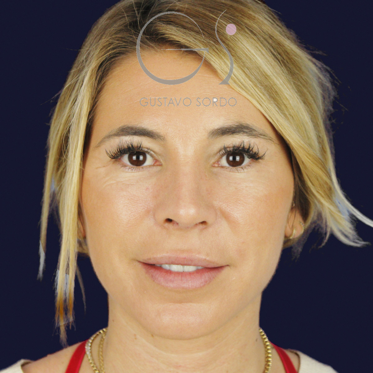 Después de rinoplastia secundaria de la punta sin costilla, a los dos meses, vista frontal